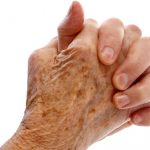 Psoriatic Arthritis Hands
