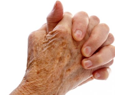 Psoriatic Arthritis Hands