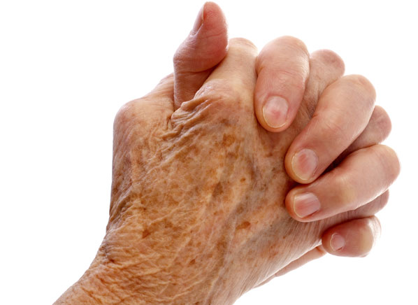 Psoriatic Arthritis Hands