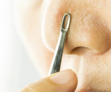 4 Perawatan Alami Usir Komedo di Hidung