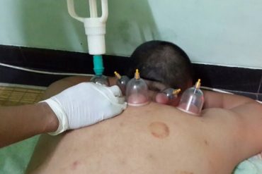Pernah Melakukan Bekam? Berikut Beberapa Pantangan Bekam