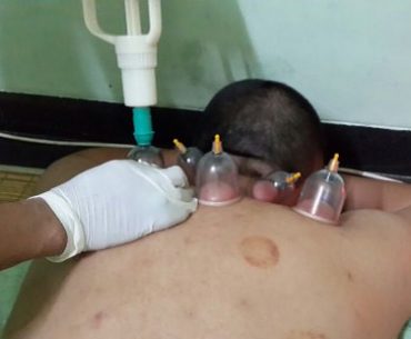 Pernah Melakukan Bekam? Berikut Beberapa Pantangan Bekam