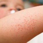 Mengidentifikasi Pendarahan Kulit