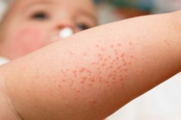 Mengidentifikasi Pendarahan Kulit