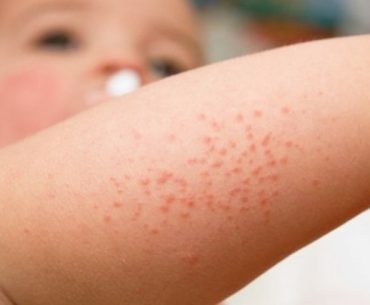 Mengidentifikasi Pendarahan Kulit