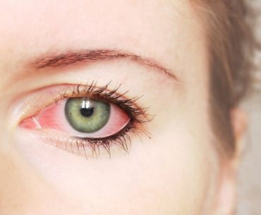 Gejala dan Pengobatan Mata Merah Muda