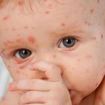Saat Bayi Mendapatkan Cacar Air