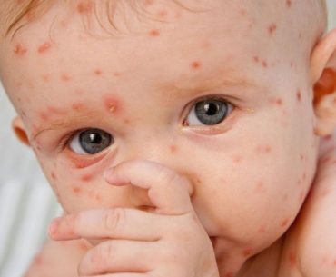 Saat Bayi Mendapatkan Cacar Air