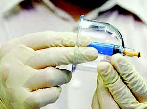 Ingin Melakukan Bekam? Kenali Biaya Untuk Bekam