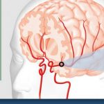 Mengetahui Serangan Stroke Jenis TIA