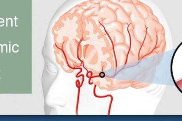 Mengetahui Serangan Stroke Jenis TIA