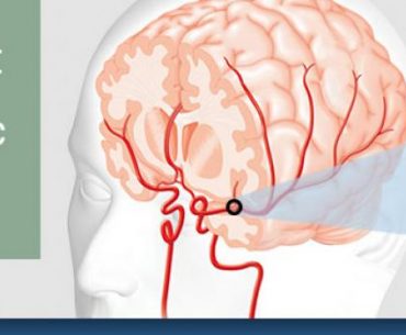 Mengetahui Serangan Stroke Jenis TIA