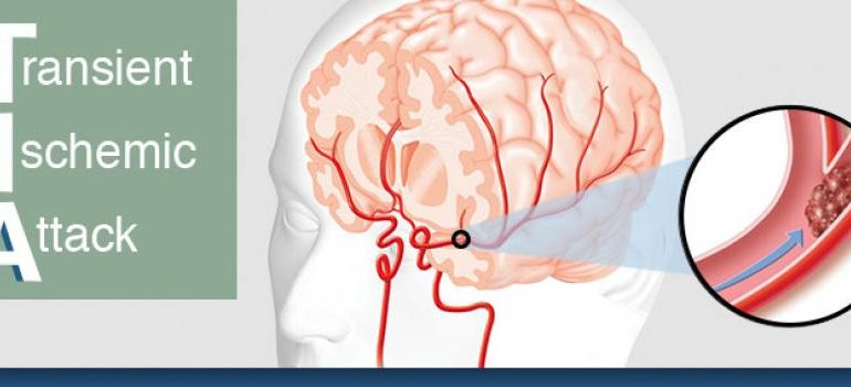 Mengetahui Serangan Stroke Jenis TIA