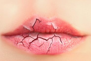 7 Hal Ini Membuat Bibirmu Semakin Kering